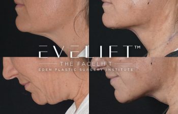 Eden Plastic Surgery Institute female patient's face before and after Eve lift procedure.