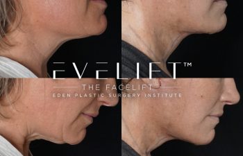 Eden Plastic Surgery Institute female patient's face before and after Eve lift procedure.