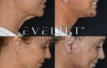 Eden Plastic Surgery Institute female patient's face before and after Eve lift procedure.