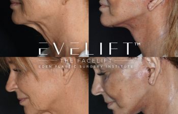Eden Plastic Surgery Institute female patient's face before and after Eve lift procedure.