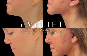 Eden Plastic Surgery Institute female patient's face before and after Eve lift procedure.