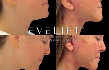 Eden Plastic Surgery Institute female patient's face before and after Eve lift procedure.