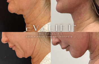 Eden Plastic Surgery Institute female patient's face before and after Eve lift procedure.