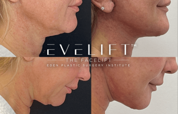 Eden Plastic Surgery Institute female patient's face before and after Eve lift procedure.