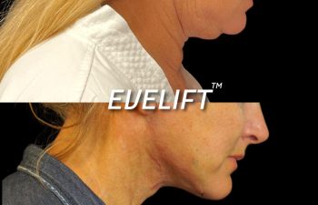 Eden Plastic Surgery Institute female patient's face before and after Eve lift procedure.