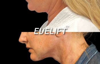 Eden Plastic Surgery Institute female patient's face before and after Eve lift procedure.