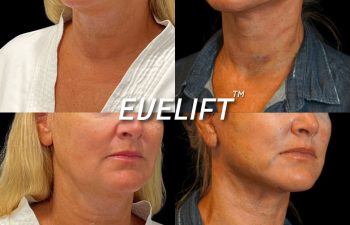 Eden Plastic Surgery Institute female patient's face before and after Eve lift procedure.