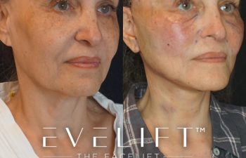 Eden Plastic Surgery Institute female patient's face before and after Eve lift procedure.