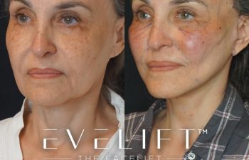 Eden Plastic Surgery Institute female patient's face before and after Eve lift procedure.