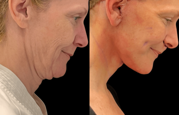 Eden Plastic Surgery Institute female patient's face before and after Eve lift procedure.