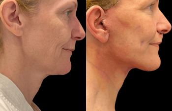 Eden Plastic Surgery Institute female patient's face before and after Eve lift procedure.