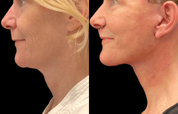 Eden Plastic Surgery Institute female patient's face before and after Eve lift procedure.