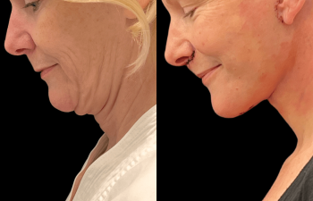 Eden Plastic Surgery Institute female patient's face before and after Eve lift procedure.