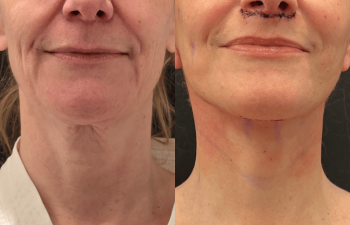 Eden Plastic Surgery Institute female patient's face before and after Eve lift procedure.