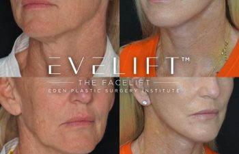 Eden Plastic Surgery Institute female patient's face before and after Eve lift procedure.