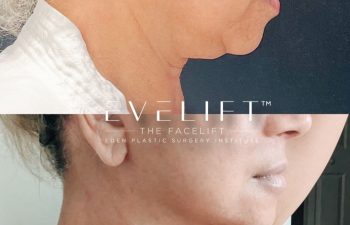 Eden Plastic Surgery Institute female patient's face before and after Eve lift procedure.
