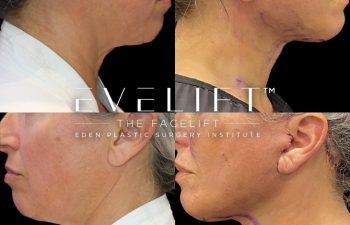 Eden Plastic Surgery Institute female patient's face before and after Eve lift procedure.