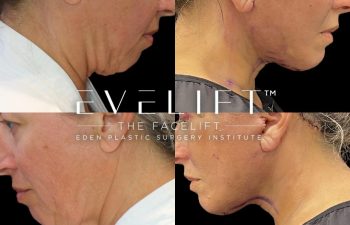 Eden Plastic Surgery Institute female patient's face before and after Eve lift procedure.
