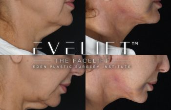 Eden Plastic Surgery Institute female patient's face before and after Eve lift procedure.