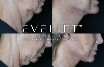 Eden Plastic Surgery Institute female patient's face before and after Eve lift procedure.