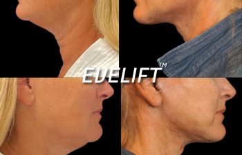 Eden Plastic Surgery Institute female patient's face before and after Eve lift procedure.