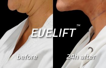 Eden Plastic Surgery Institute female patient's face before and after Eve lift procedure.