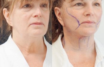 Eden Plastic Surgery Institute female patient's face before and after Eve lift procedure.