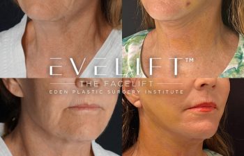 Eden Plastic Surgery Institute female patient's face before and after Eve lift procedure.