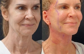Eden Plastic Surgery Institute female patient's face before and after Eve lift procedure.