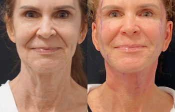 Eden Plastic Surgery Institute female patient's face before and after Eve lift procedure.