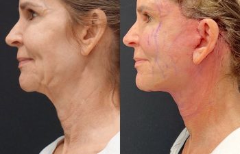 Eden Plastic Surgery Institute female patient's face before and after Eve lift procedure.