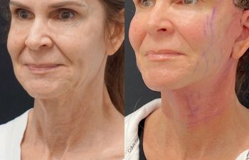 Eden Plastic Surgery Institute female patient's face before and after Eve lift procedure.