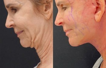 Eden Plastic Surgery Institute female patient's face before and after Eve lift procedure.
