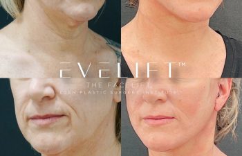 Eden Plastic Surgery Institute female patient's face before and after Eve lift procedure.