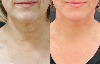 Eden Plastic Surgery Institute female patient's face before and after Eve lift procedure.