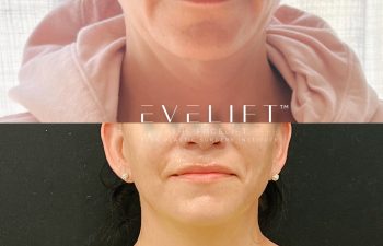 Eden Plastic Surgery Institute female patient's face before and after Eve lift procedure.