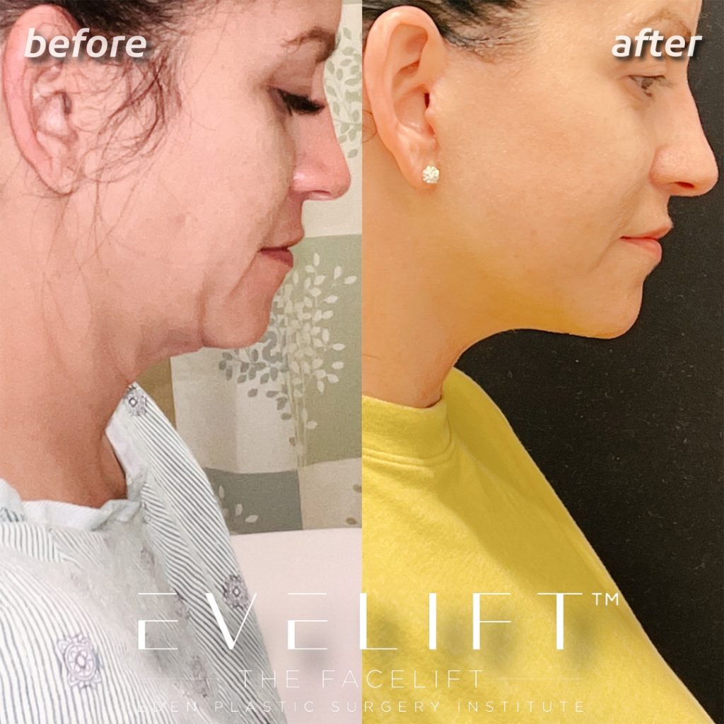 Eden Plastic Surgery Institute female patient's face before and after Eve lift procedure.