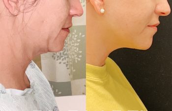 Eden Plastic Surgery Institute female patient's face before and after Eve lift procedure.