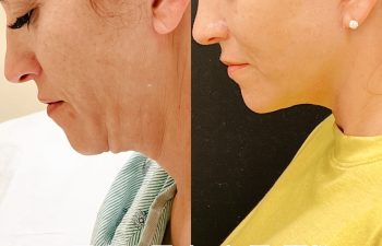 Eden Plastic Surgery Institute female patient's face before and after Eve lift procedure.