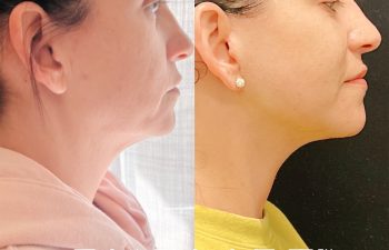 Eden Plastic Surgery Institute female patient's face before and after Eve lift procedure.