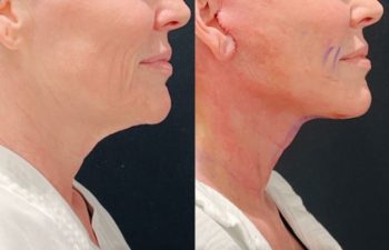 Eden Plastic Surgery Institute female patient's face before and after Eve lift procedure.