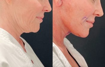 Eden Plastic Surgery Institute female patient's face before and after Eve lift procedure.