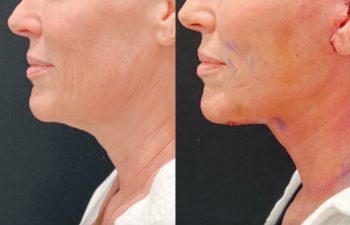 Eden Plastic Surgery Institute female patient's face before and after Eve lift procedure.