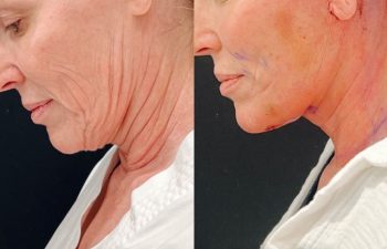 Eden Plastic Surgery Institute female patient's face before and after Eve lift procedure.