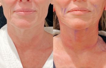 Eden Plastic Surgery Institute female patient's face before and after Eve lift procedure.