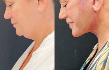 Eden Plastic Surgery Institute female patient's face before and after Eve lift procedure.