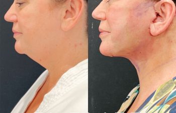 Eden Plastic Surgery Institute female patient's face before and after Eve lift procedure.