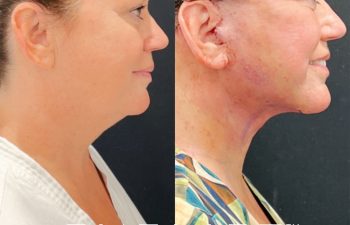 Eden Plastic Surgery Institute female patient's face before and after Eve lift procedure.