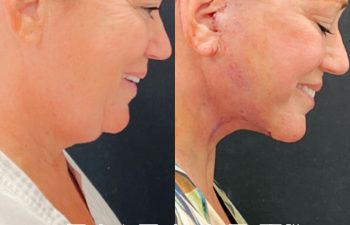 Eden Plastic Surgery Institute female patient's face before and after Eve lift procedure.