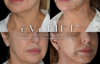 Eden Plastic Surgery Institute female patient's face before and after Eve lift procedure.